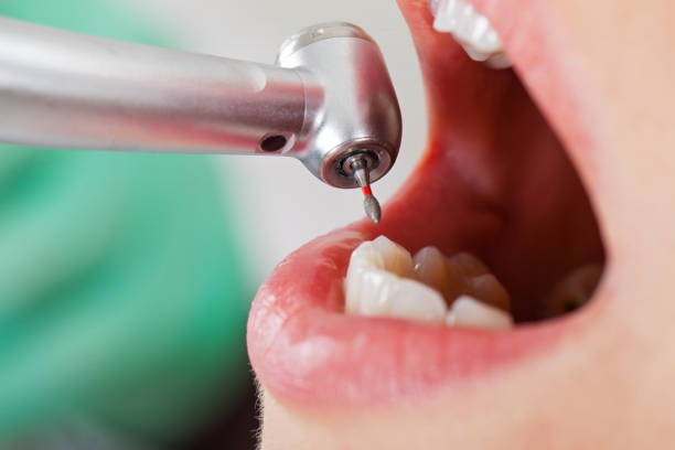 Best Emergency Tooth Extraction in Americus, GA